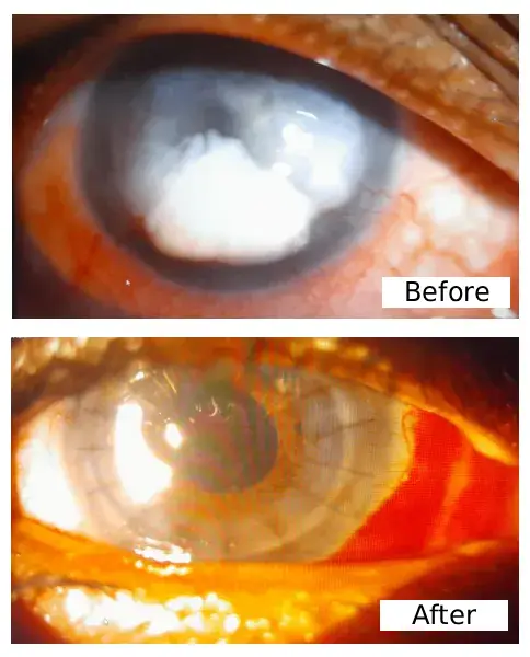 Consult Cornea Specialist